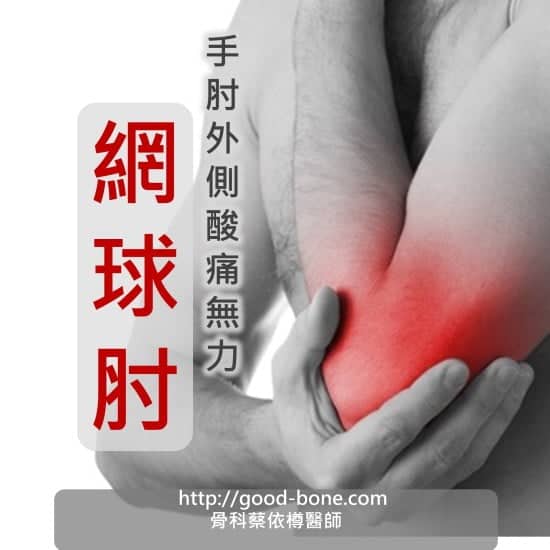 手肘外側痠痛無力 網球肘 MB 骨科蔡依樽醫師 https://www.good-bone.com/