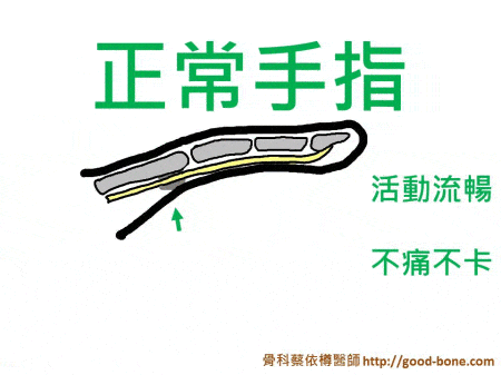 跟扳機指比較的正常手指肌腱卡通動態示意圖gif。