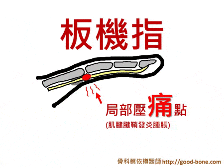 扳機指的卡通動態示意圖gif。