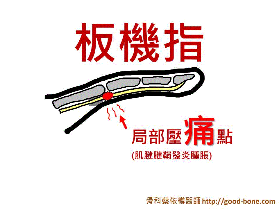 扳機指的卡通動態示意圖gif。