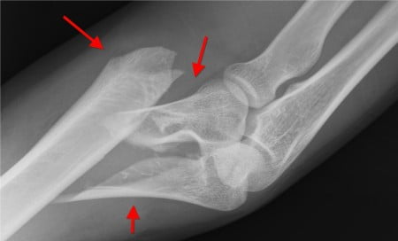 elbow-fx (2)