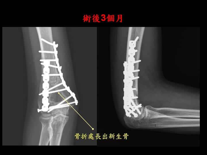 專業手術 職業運動員的手肘骨折 台中骨科蔡依樽醫師 親切 專業 更用心