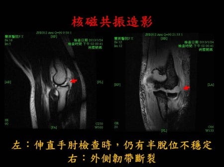 elbow-fx-dislocation (3)