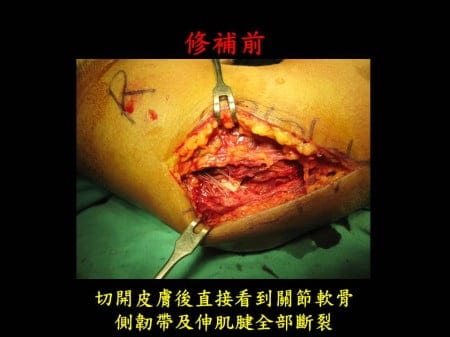 elbow-fx-dislocation (4)