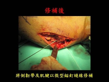 elbow-fx-dislocation (5)