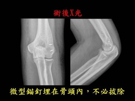 elbow-fx-dislocation (6)