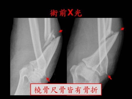 elbow-fx2- (1)