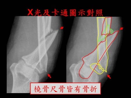 elbow-fx2- (2)