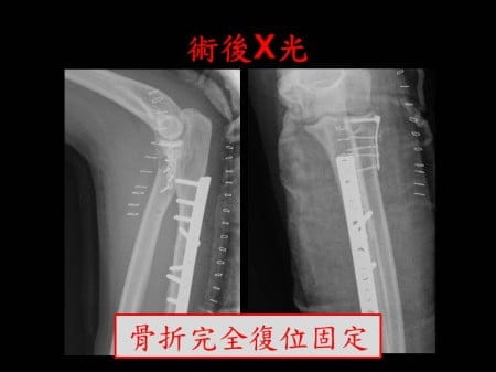 elbow-fx2- (3)