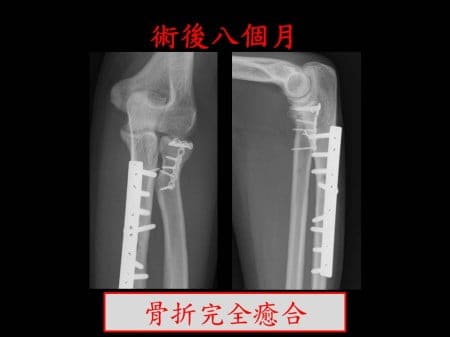 elbow-fx2- (6)
