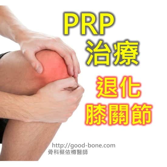 PRP 治療 退化膝關節 MB 骨科蔡依樽醫師 https://www.good-bone.com/