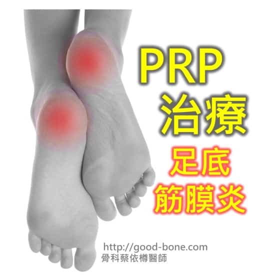 PRP 治療 足底筋膜炎 MB 骨科蔡依樽醫師 https://www.good-bone.com/