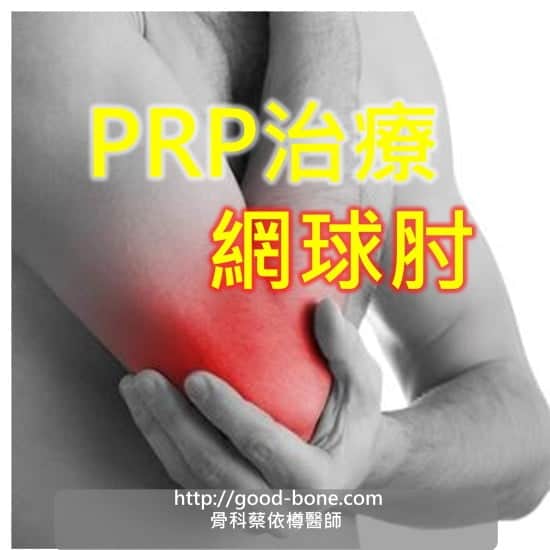 PRP 治療 網球肘 MB 骨科蔡依樽醫師 https://www.good-bone.com/