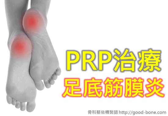 prp-plantar-fasciitis-01