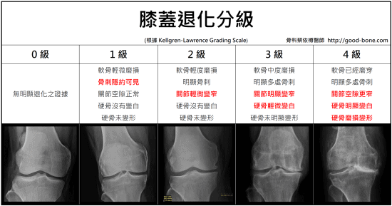 膝關節分級 Kellgren-Lawrence ; FB 骨科蔡依樽醫師 https://good-bone.com/