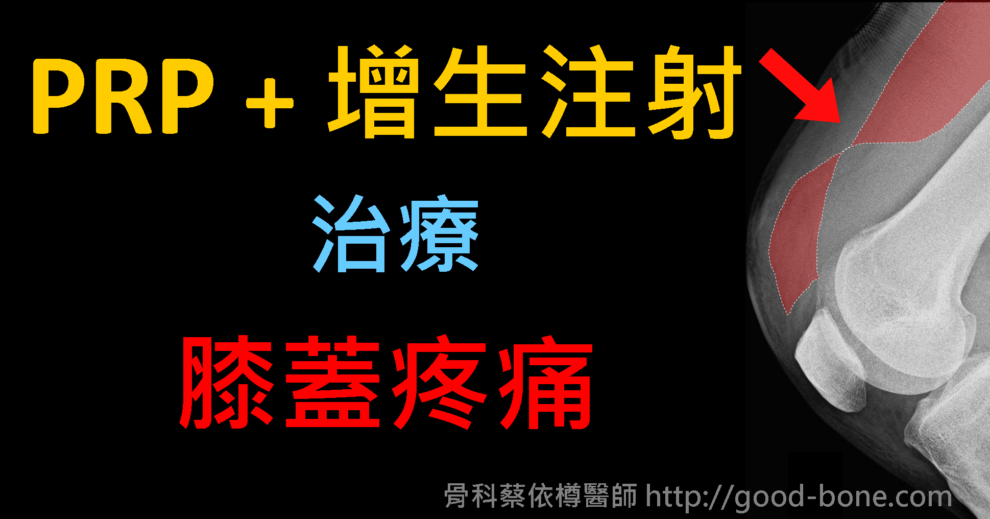 案例分享04 Prp 增生注射治療陳舊型股四頭肌斷裂 初期膝關節退化 骨科蔡依樽醫師