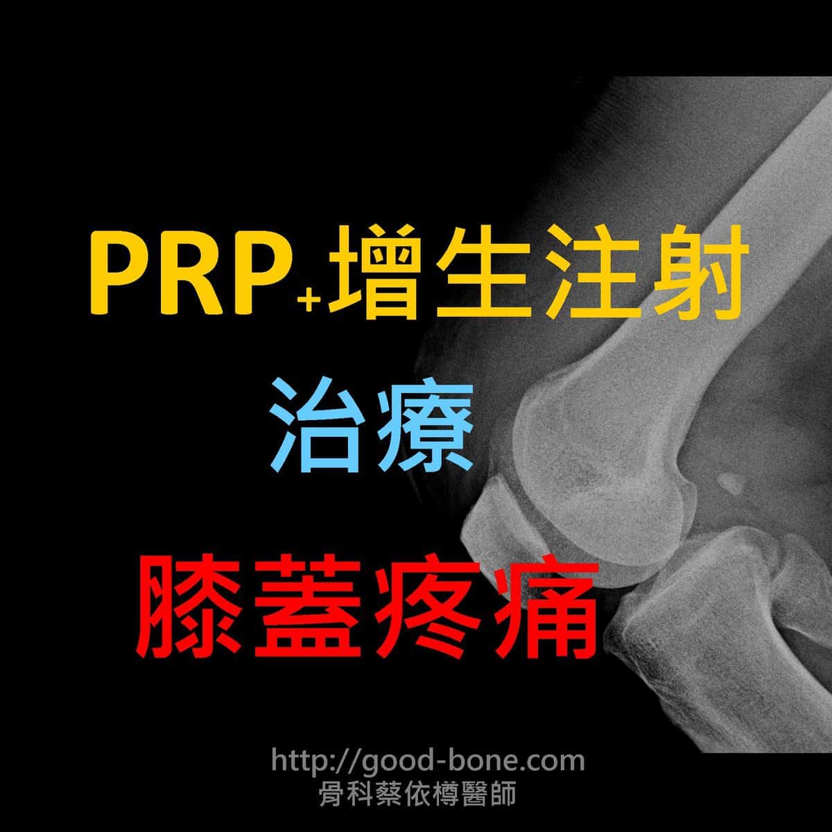 案例分享04 Prp 增生注射治療陳舊型股四頭肌斷裂 初期膝關節退化 骨科蔡依樽醫師