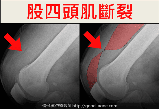 案例分享04 Prp 增生注射治療陳舊型股四頭肌斷裂 初期膝關節退化 骨科蔡依樽醫師