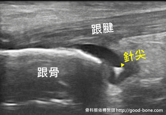 超音波導引注射治療腳後跟痛|台中骨科蔡依樽醫師https://good-bone.com