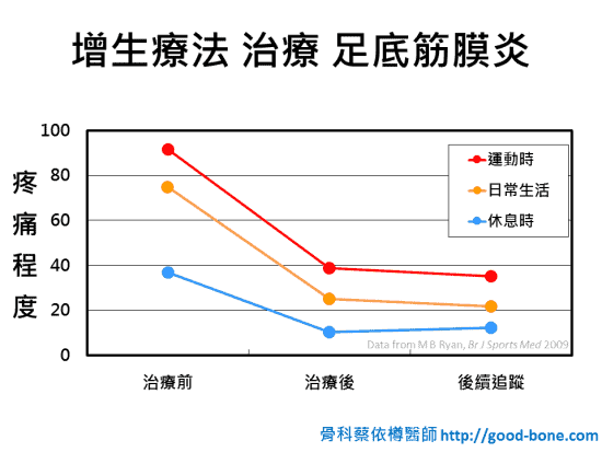 增生注射治療足底筋膜炎|台中骨科蔡依樽醫師https://good-bone.com