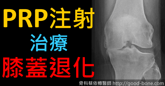 HomePage-FB-case010-prp-oa-knee