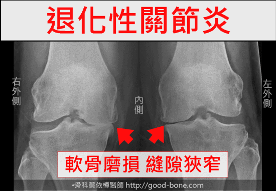 HomePage-case010-prp-oa-knee