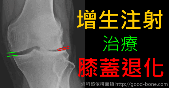 增生注射治療希蓋退化|台中骨科蔡依樽醫師https://good-bone.com