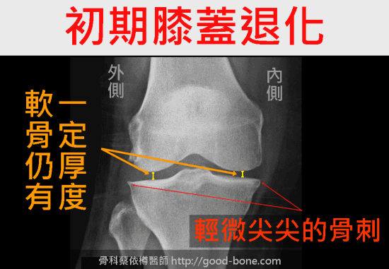 增生注射治療膝蓋疼痛|台中骨科蔡依樽醫師https://good-bone.com