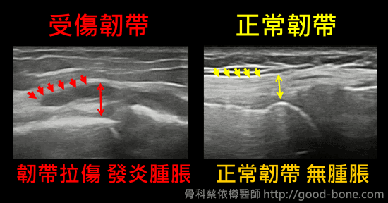 導引PRP注射治療膝韌帶拉傷｜專業骨科推薦｜台中骨科蔡依樽醫師https://good-bone.com