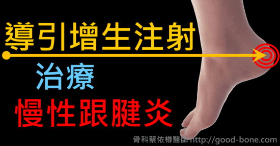 導引增生注射治療慢性跟腱炎｜專業骨科推薦｜台中骨科蔡依樽醫師https://good-bone.com