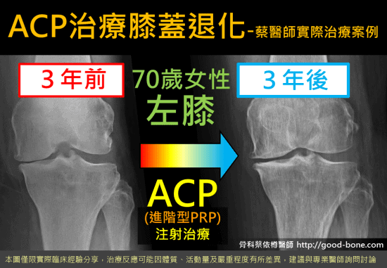 超音波導引PRP 注射治療膝蓋退化｜專業骨科推薦｜台中骨科蔡依樽醫師https://good-bone.com