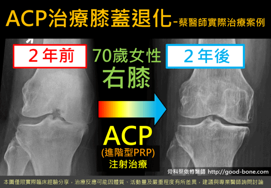 超音波導引PRP 注射治療膝蓋退化｜專業骨科推薦｜台中骨科蔡依樽醫師https://good-bone.com