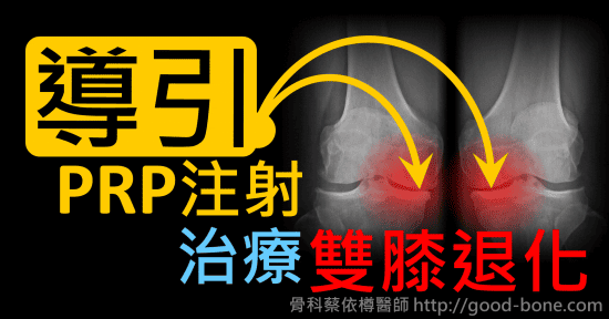 超音波導引PRP 注射治療雙膝蓋退化疼痛關節炎｜疼痛注射專家、超音波導引PRP增生治療、專業骨科推薦｜台中骨科蔡依樽醫師https://good-bone.com