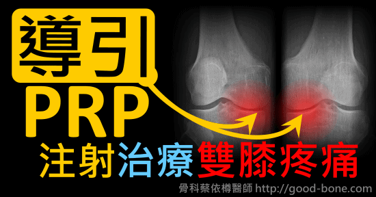 超音波導引PRP 注射治療雙膝蓋退化疼痛關節炎｜疼痛注射專家、超音波導引PRP增生治療、專業骨科推薦｜台中骨科蔡依樽醫師https://good-bone.com