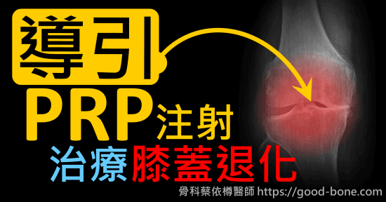 超音波導引PRP 注射治療雙膝蓋退化疼痛關節炎｜疼痛注射專家、超音波導引PRP增生治療、專業骨科推薦｜台中骨科蔡依樽醫師https://good-bone.com