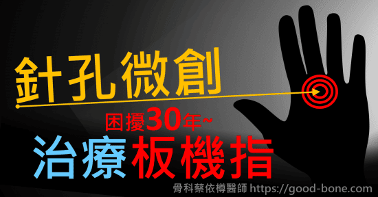 針孔微創治療手指卡卡困擾30年的板機指｜專業骨科推薦｜台中骨科蔡依樽醫師https://good-bone.com