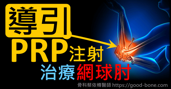 超音波導引PRP 注射治療網球肘、手肘疼痛｜疼痛注射專家、超音波導引PRP增生治療、專業骨科推薦｜台中骨科蔡依樽醫師https://good-bone.com