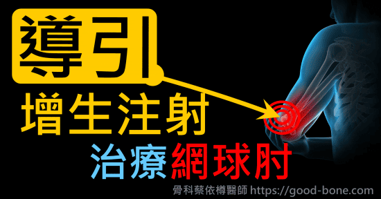 超音波導引葡萄糖增生注射治療網球肘、手肘疼痛｜疼痛注射專家、超音波導引PRP增生治療、專業骨科推薦｜台中骨科蔡依樽醫師https://good-bone.com