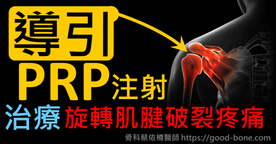 超音波導引PRP 注射治療左肩膀旋轉肌腱韌帶破裂疼痛、韌帶撕裂｜疼痛注射專家、超音波導引PRP增生治療、扳機指微創治療免開刀、專業骨科推薦｜台中骨科蔡依樽醫師https://good-bone.com