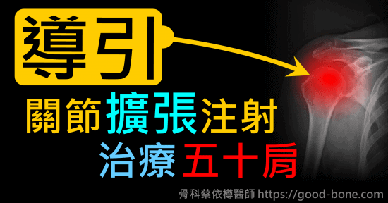 超音波導引關節擴張注射治療五十肩肩膀疼痛沾黏｜專業骨科推薦｜台中骨科蔡依樽醫師https://good-bone.com