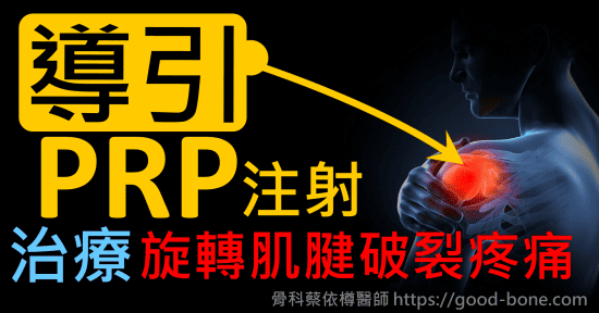 超音波導引PRP 注射治療左肩膀旋轉肌腱韌帶破裂疼痛、韌帶撕裂｜疼痛注射專家、超音波導引PRP增生治療、葡萄糖注射治療、扳機指微創治療免開刀、專業骨科推薦｜台中骨科蔡依樽醫師https://good-bone.com