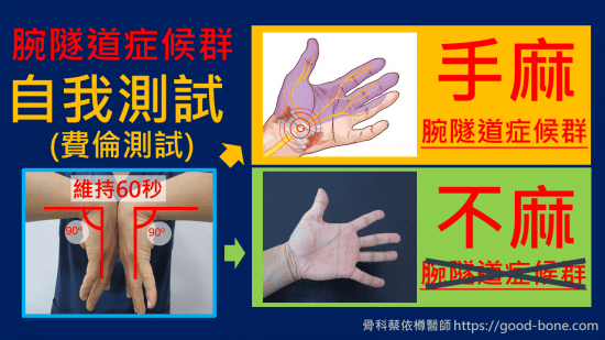 carpal tunnel syndrome, 腕隧道症候群，正中神經壓迫，超音波導引正中神經解套注射，治療前後比較，費倫測試、tinel sign, phalen test, median nerve compression neuropathy, 疼痛注射專家、超音波導引PRP增生治療、五十肩關節擴張注射治療、扳機指微創治療手術、網球肘、高爾夫球肘、媽媽手、膝蓋退化、專業骨科推薦｜台中骨科蔡依樽醫師https://good-bone.com