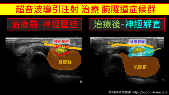 carpal tunnel syndrome, 腕隧道症候群，正中神經壓迫，超音波導引正中神經解套注射，治療前後比較，費倫測試、tinel sign, phalen test, median nerve compression neuropathy, 疼痛注射專家、超音波導引PRP增生治療、五十肩關節擴張注射治療、扳機指微創治療手術、網球肘、高爾夫球肘、媽媽手、膝蓋退化、專業骨科推薦｜台中骨科蔡依樽醫師https://good-bone.com